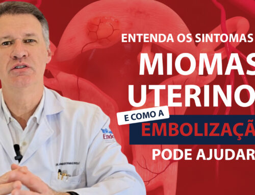 Embolização Uterina – Miomas Uterinos – Dr. Alexander Corvello